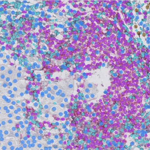 Developing an AI model for multiplex analysis of immune subpopulations in breast cancer