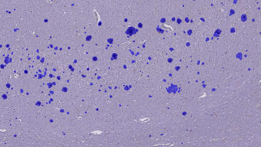 Case study: AI-assisted image analysis of neurodegenerative disease markers