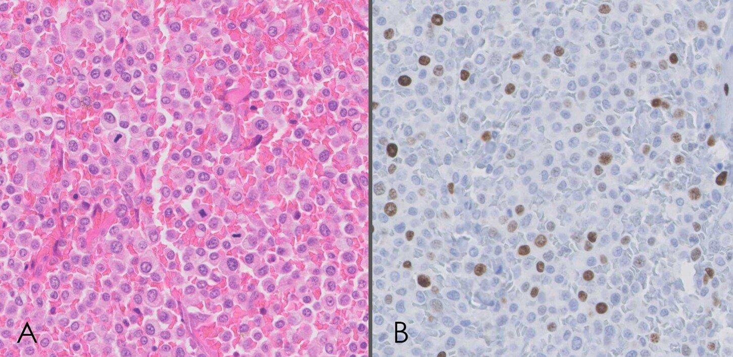 Finn Pathologists case study: Ki-67 scoring of canine mast cell tumors