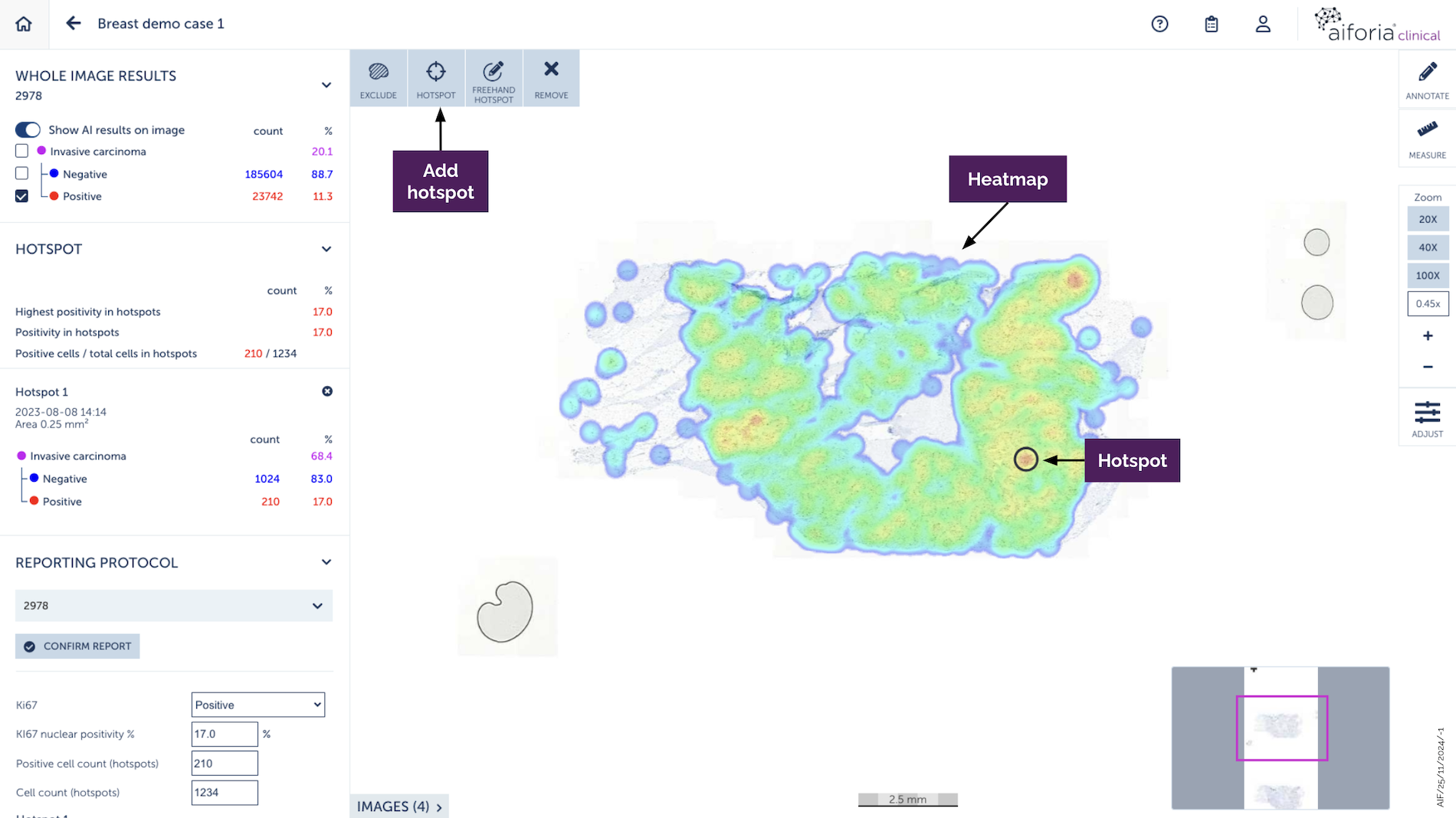 breast-cancer-clinical-viewer