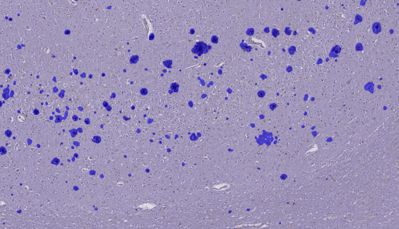 Case study_ AI-assisted image analysis of neurodegenerative disease markers_image