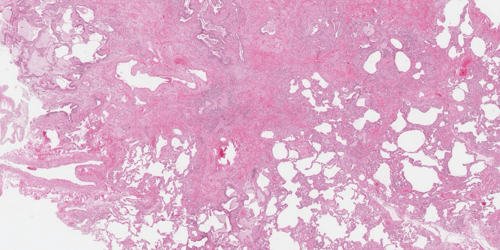 Case study: differentiating interstitial lung disease subtypes using AI-based image analysis