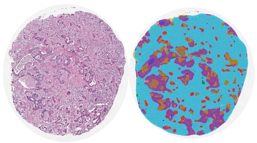 Leveraging AI-driven quantitative pathology to identity novel prognostic histologic signatures in colorectal carcinoma