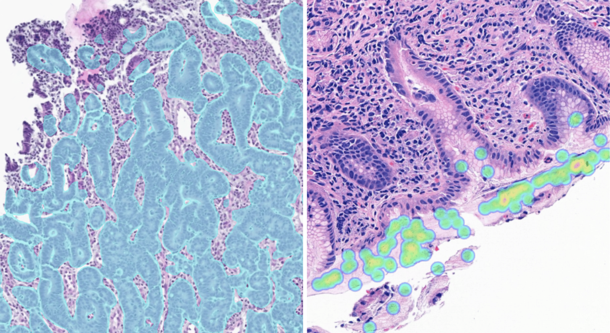 Gastric and H pylori