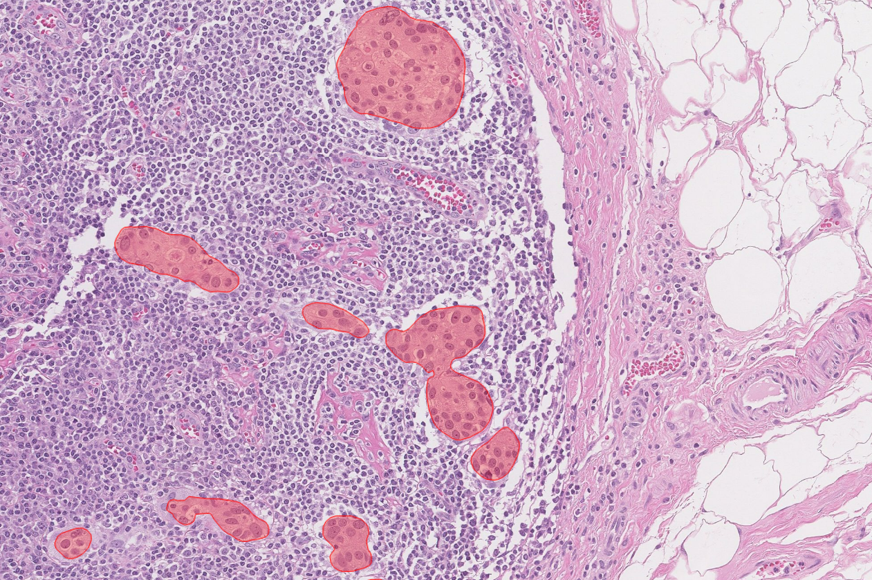 aiforia-lymph-node-metastasis-breast