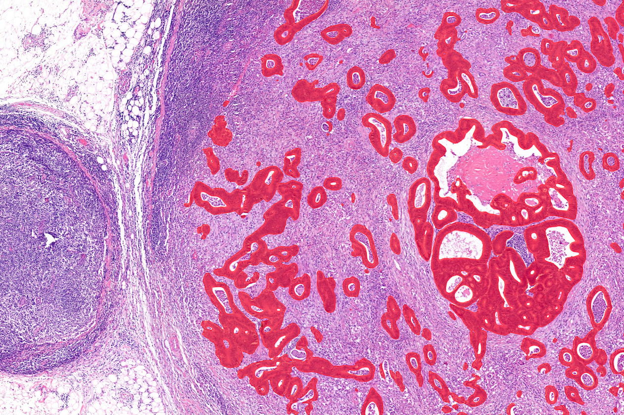 aiforia-lymph-node-metastasis