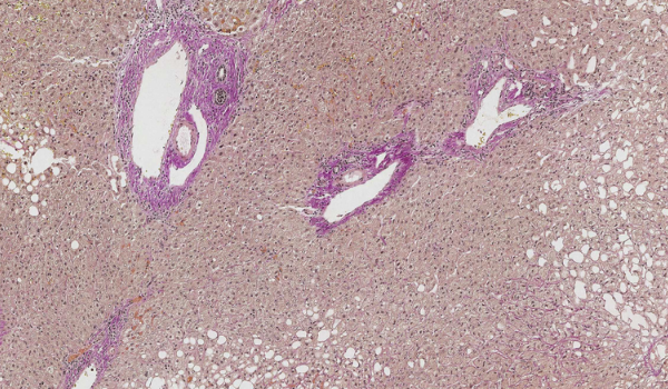 NAFLD case study: assessing liver histology with AI