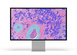 Breast Cancer Grading_monitor 1