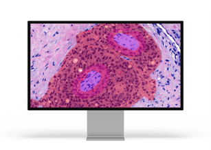 Prostate Cancer PNI_monitor 1