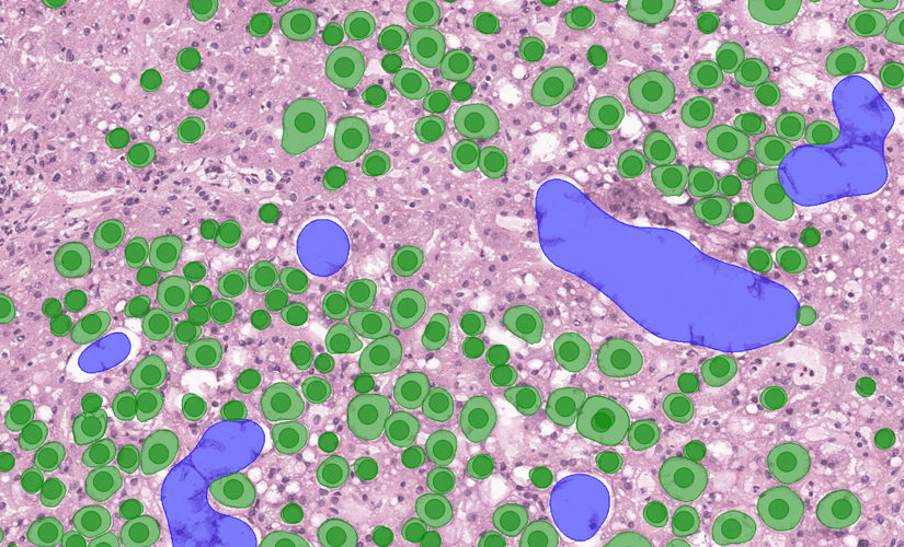 Case study: AI model can improve large droplet fat quantitation in liver pathology